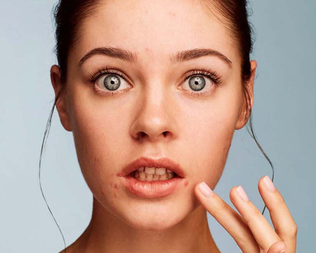 Acne Prone Skin Skincare Habits That May Worsen Acne Skin